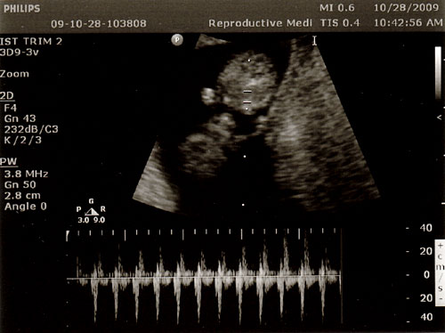 scan-10w1d-heart