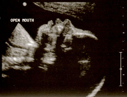 ultrasound-28week-1a