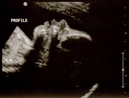 ultrasound-28week-2a