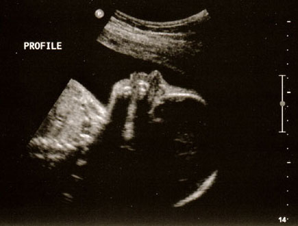 ultrasound-28week-3a