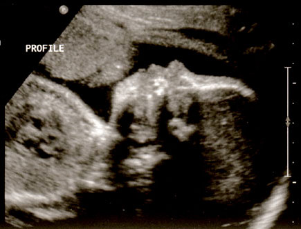 ultrasound-28week-4a